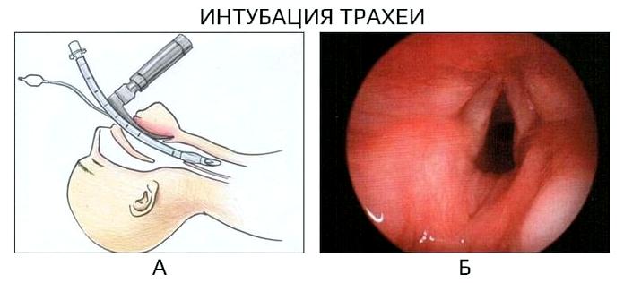 Проходимость дыхательных путей - основа любой экстренной помощи Проходимость дыхательных путей - основа любой экстренной помощи