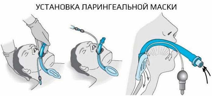 Проходимость дыхательных путей - основа любой экстренной помощи Проходимость дыхательных путей - основа любой экстренной помощи
