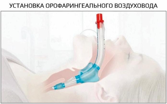 Проходимость дыхательных путей - основа любой экстренной помощи Проходимость дыхательных путей - основа любой экстренной помощи