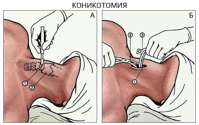 Проходимость дыхательных путей - основа любой экстренной помощи Проходимость дыхательных путей - основа любой экстренной помощи