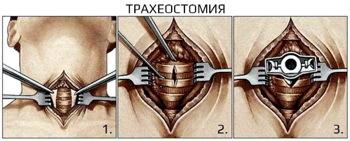 Проходимость дыхательных путей - основа любой экстренной помощи Проходимость дыхательных путей - основа любой экстренной помощи