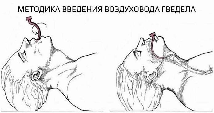 Проходимость дыхательных путей - основа любой экстренной помощи Проходимость дыхательных путей - основа любой экстренной помощи