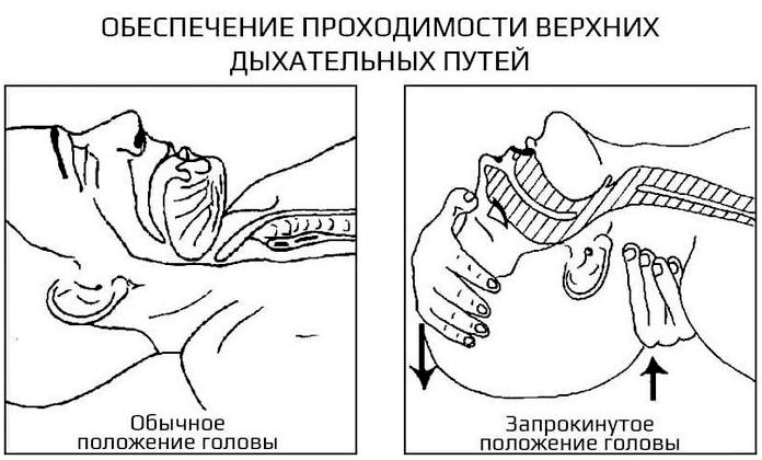 Проходимость дыхательных путей - основа любой экстренной помощи Проходимость дыхательных путей - основа любой экстренной помощи