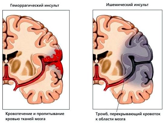 «Китайская» помощь при инсультах. Польза или вред?