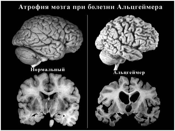 Употребление рыбы снижает риск болезни Альцгеймера
