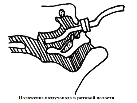 Восстановление проходимости дыхательных путей, искусственное дыхание, непрямой массаж сердца, особенности проведения.