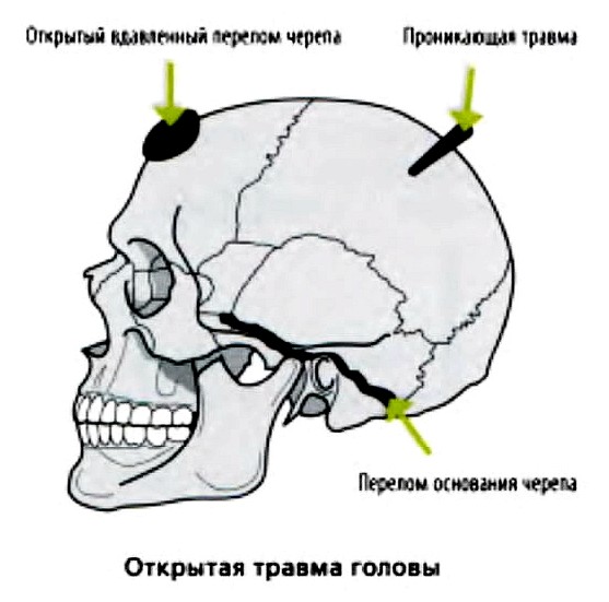 Выделяют три типа открытой травмы головы