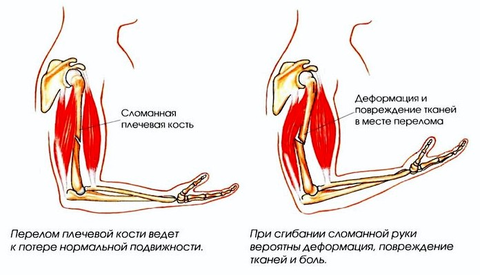 Перелом плечевой кости ведет к потере нормальной подвижности