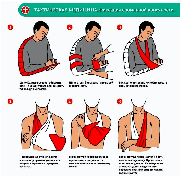 Применение санитарной косынки для иммобилизации конечности при огнестрельных ранениях, переломах и травмах